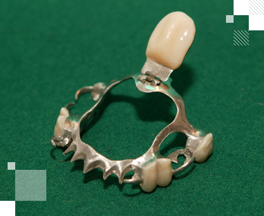 Шинирующий бюгельный протез