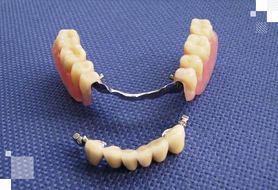 Протез на аттачментах бюгельный