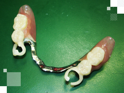Протез на кламмерах бюгельный