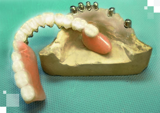Протез на телескопических коронках