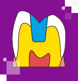 Инлей вкладки