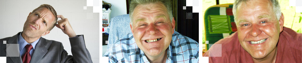 В каких случаях нужно ставить мостовидный протез?