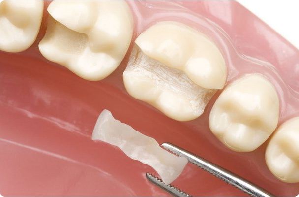 Немпрямой способ реставрации