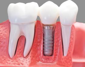 Імплантація