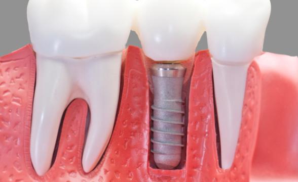 Імплантація