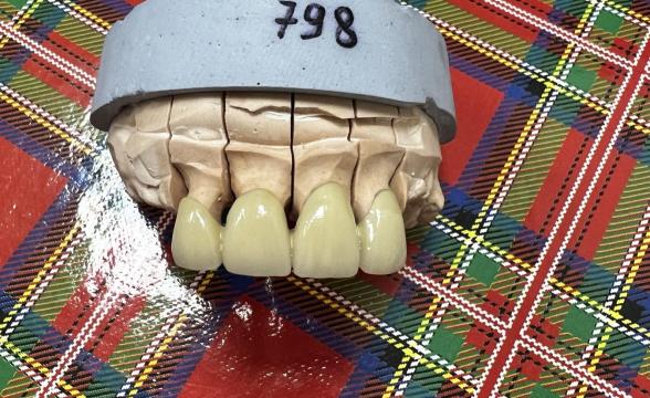 Якщо ви шукаєте якісне та доступне рішення для відновлення зубів, металокерамічні коронки стануть чудовим вибором. Це перевірена часом технологія, яка забезпечує баланс між міцністю, естетикою та ціною.